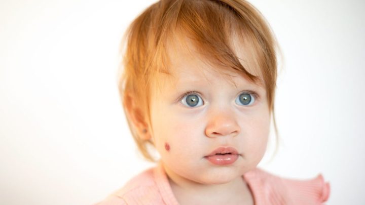 Bébé vu de profil avec une petite tache rouge visible sur la joue, évoquant un angiome.